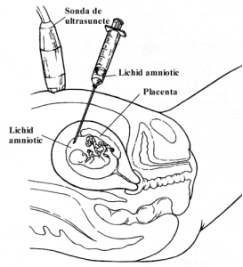 amniocenteza