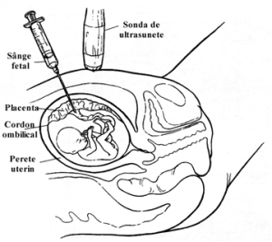 cordonocenteza