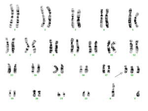 trisomie 18