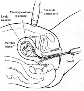 trofocenteza